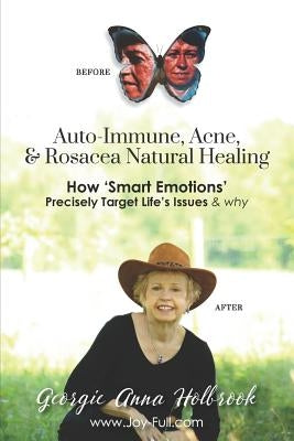 Auto-Immune, Acne, & Rosacea Natural Healing - How 'Smart Emotions' Precisely Target Life's Issues & Why by Holbrook, Georgie Anna